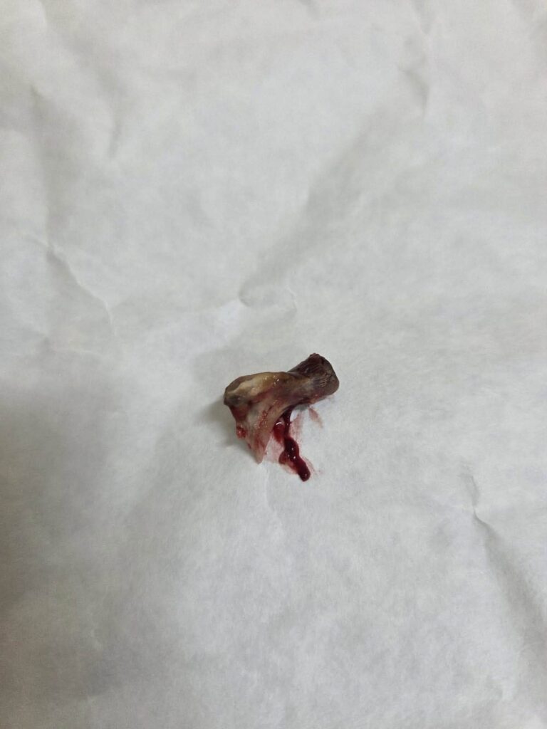 859107130 122275863386083593 2831247759841791 n - Un bătrân a ajuns de urgență la spital după ce s-a înecat cu un os. Medicii din Iași i-au salvat viața